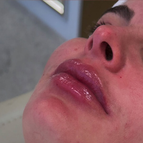 Preenchimento Labial