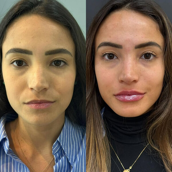 Harmonização Facial