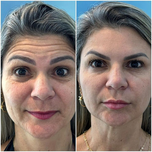 Toxina Botulínica e Bioestimuladores de Colágeno