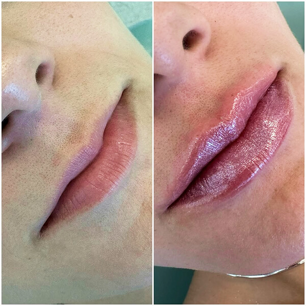 Preenchimento Labial