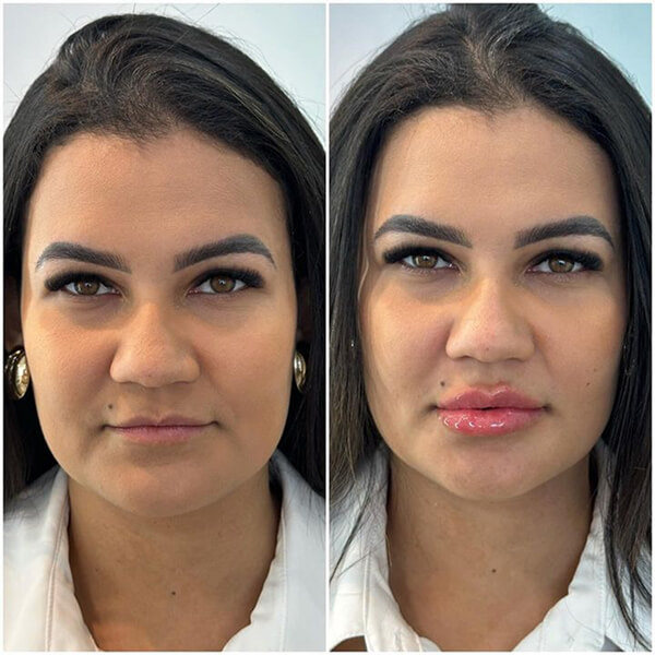 Preenchimento Labial