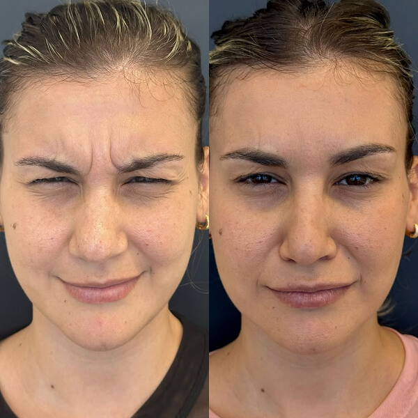 Aplicação de Toxina Botulínica