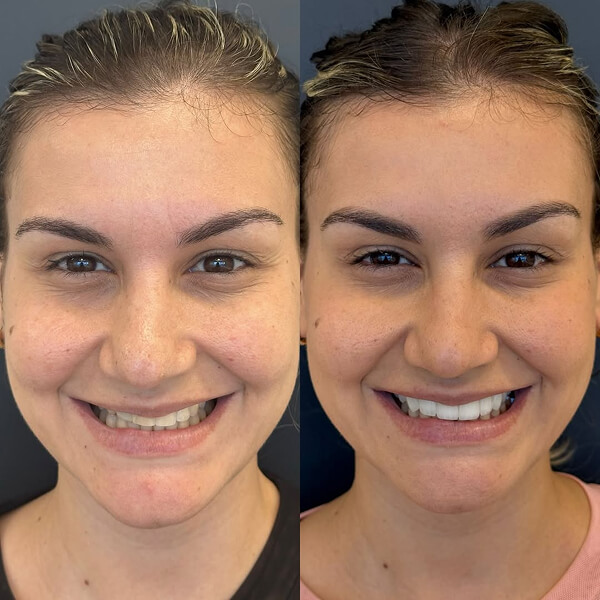 Aplicação de Toxina Botulínica