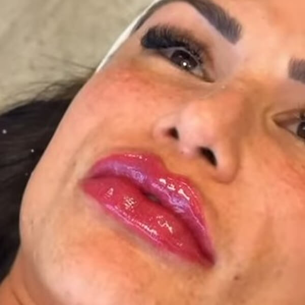 Preenchimento Labial