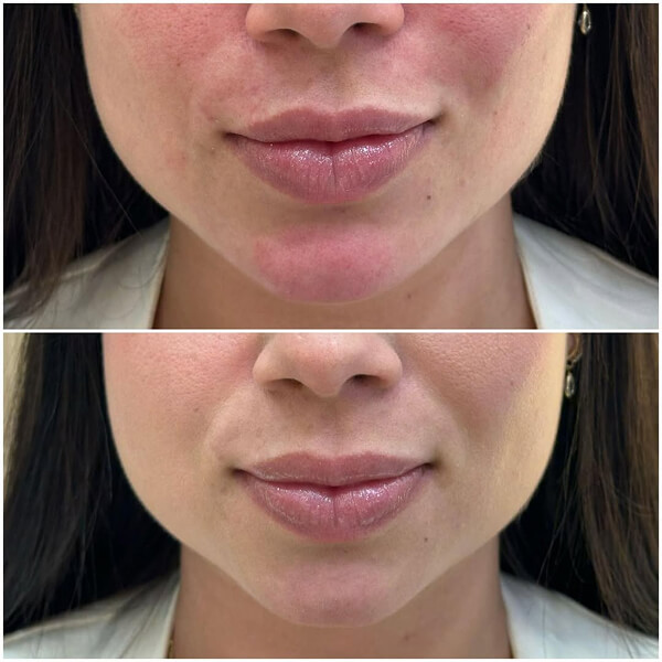 Harmonização Facial