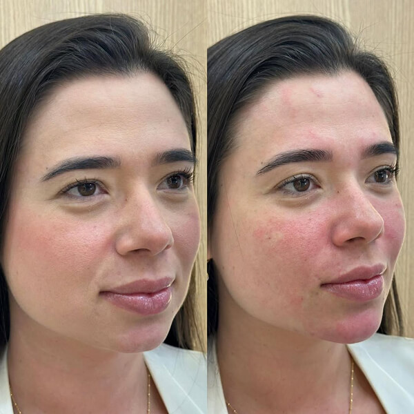Harmonização Facial