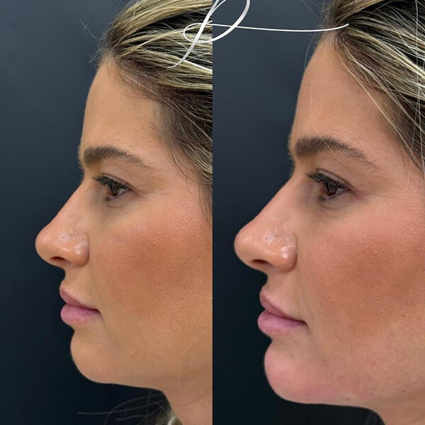 Harmonização Facial