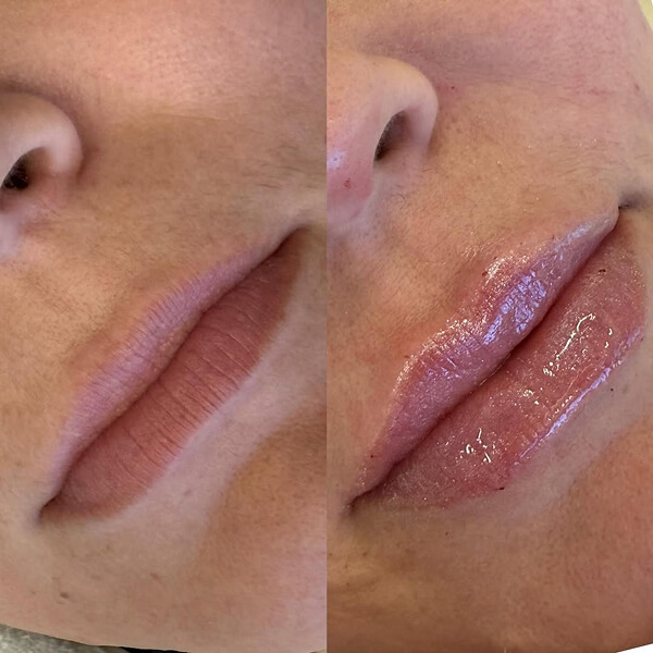 Preenchimento Labial